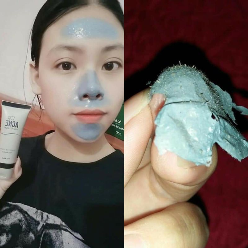 Gel Lột Mụn - DR.ACNE - (giá sỉ 10 SP)