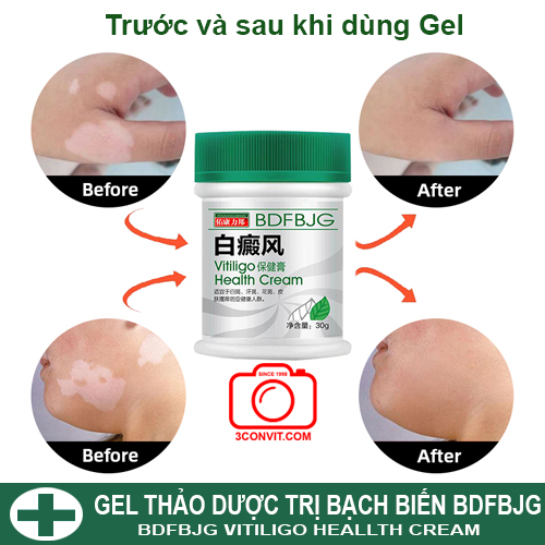 Gel thảo dược bạch biến BDFB