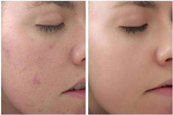 Kem chấm mụn Rugby Acne Medication 5% - Rugby