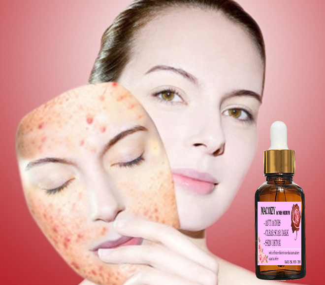 [HCM]Serum Giảm Mụn Mờ Thâm Macoizy Của Pháp
