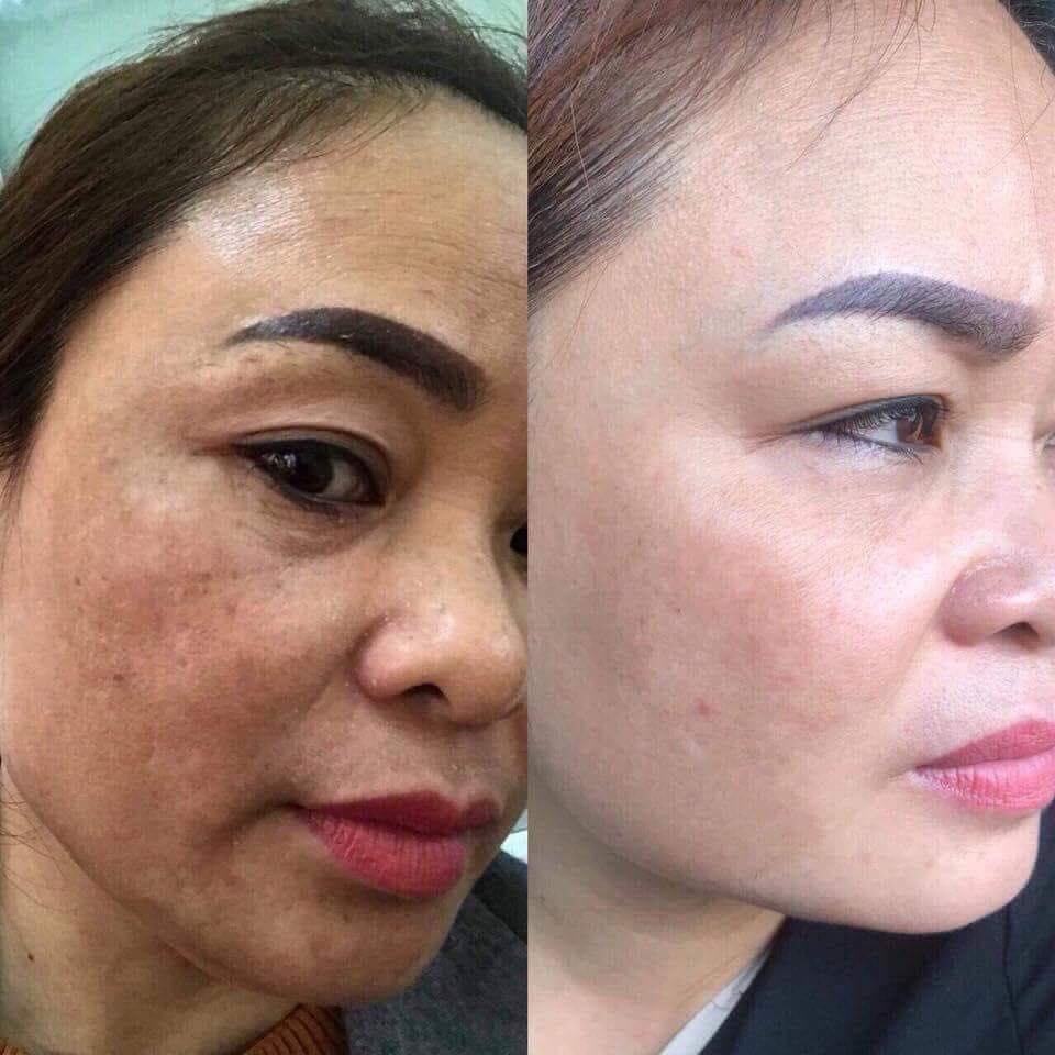 [HCM]Bộ Đôi Kem Nám Tàn Nhang Dưỡng Trắng