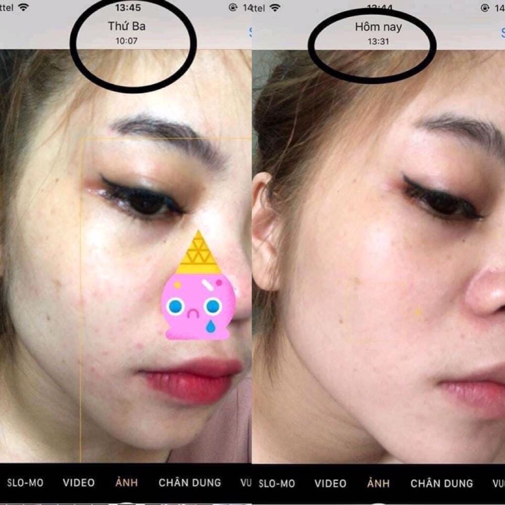 KEM TRỊ MỤN HT BEAUTY