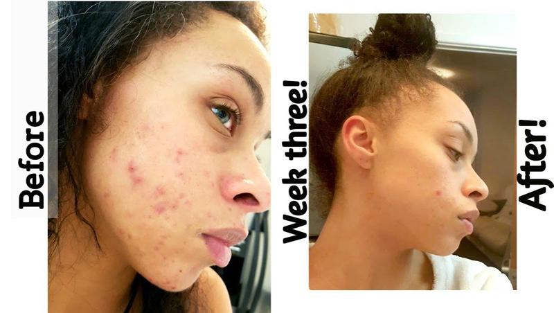 [HCM]Tinh Chất Giảm mụn The Ordinary Salicylic Acid 2% Solution