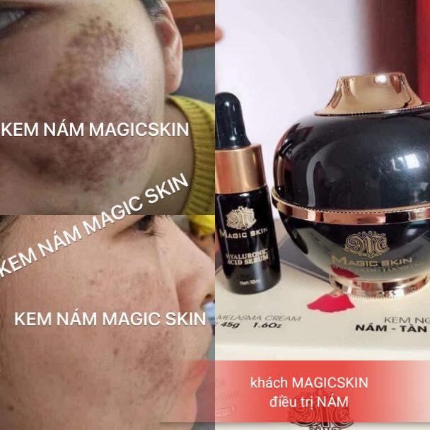 KEM NGỪA NÁM TAN NHANG MAGIC SKIN