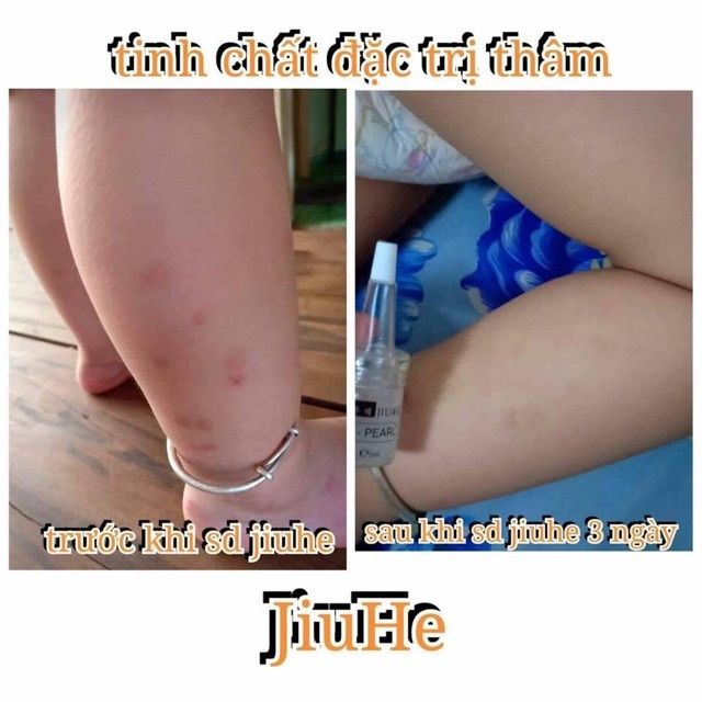 Serum Tri Thâm Jiuhe