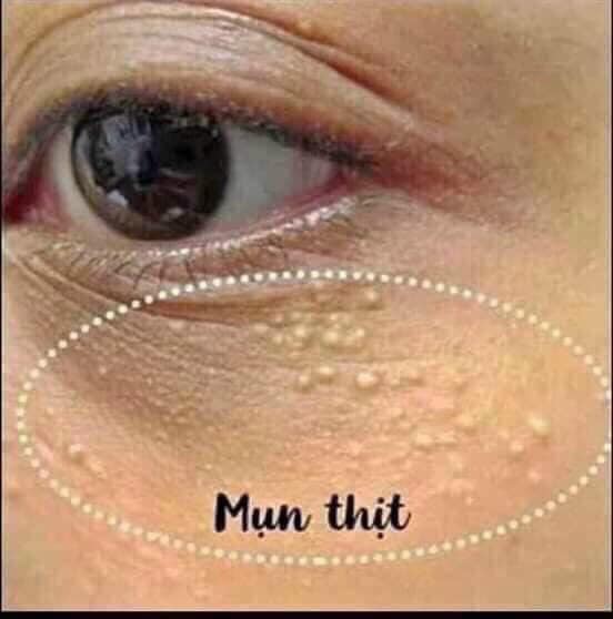 Kem trị mụn thịt Tsubuporon của Nhật
