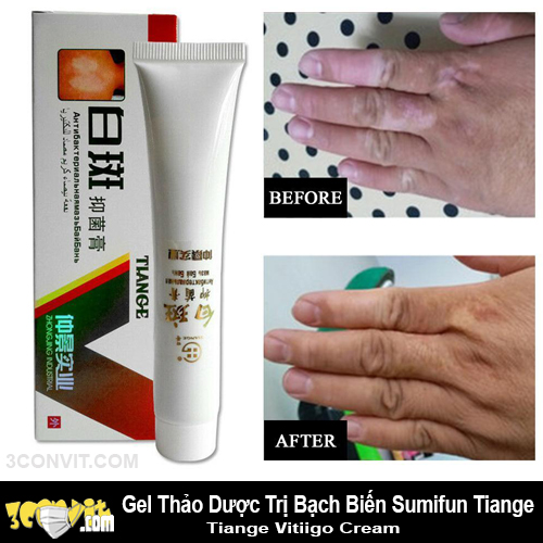 Thảo dược bôi bạch biến
