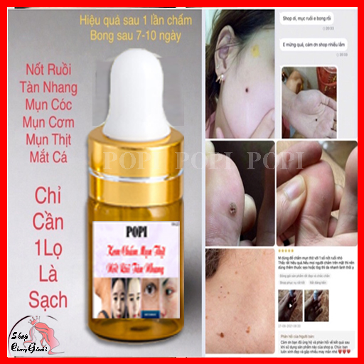 KEM TẨY MỤN CƠM, MỤN CÓC, NỐT RUỒI, MỤN THỊT, TÀN NHANG POPI