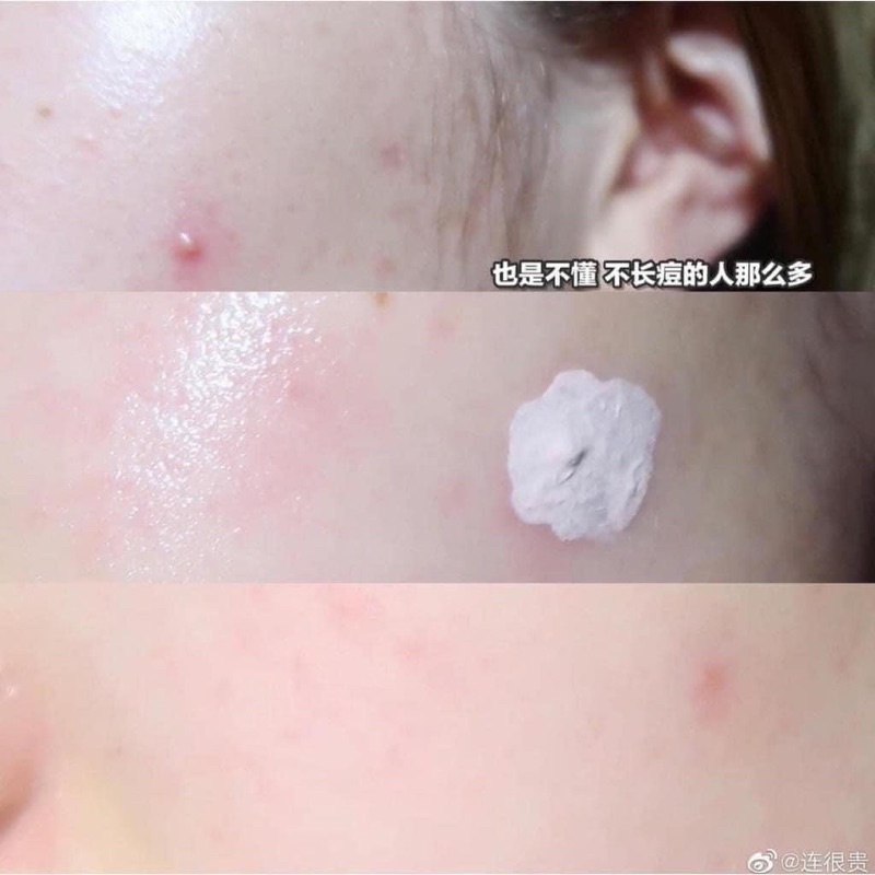 CHẤM MỤN NEOGEN A-CLEAR GIẢM MỤN HIỆU QUẢ