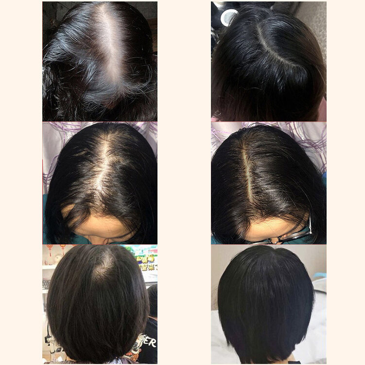 Thuốc mọc tóc serum kích mọc tóc chống rụng tóc kích mọc tóc chăm sóc tóc 30ml  kích thích mọc tóc nhanh làm dày