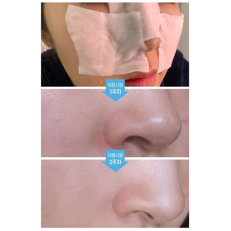 [Chính Hãng] Dung Dịch Ủ Mụn Đầu Đen Medi-peel Extra Super 9 Hàn Quốc