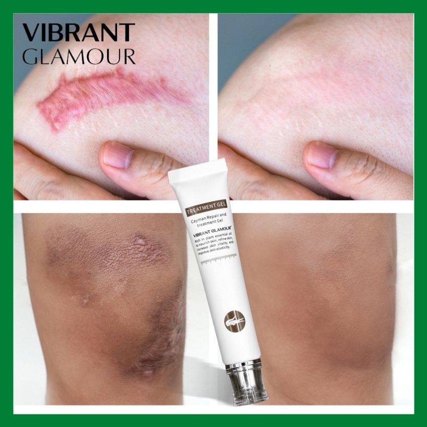 [HCM]Kem Làm Mờ Sẹo Giảm Thâm Vết Sẹo