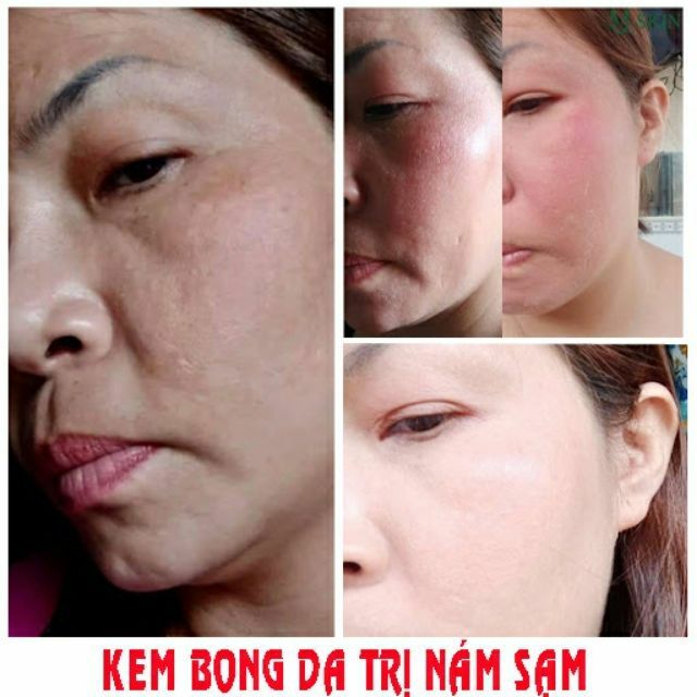 [HCM]KEM KÍCH BONG DA THAILAN