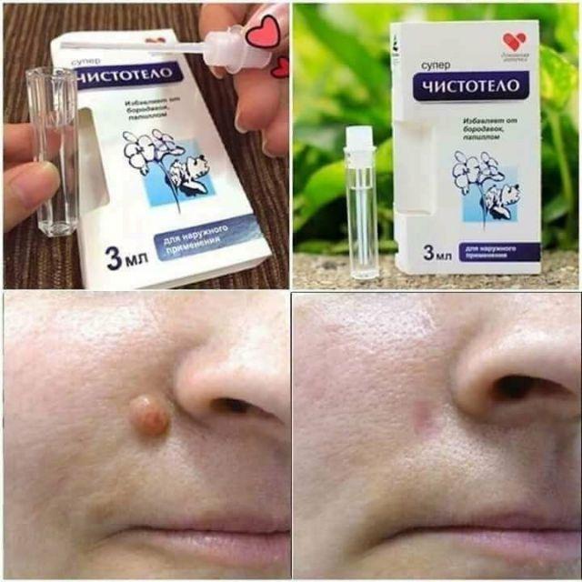 [HCM]Tẩy nốt ruồi mụn cơm mun cóc chuẩn nga