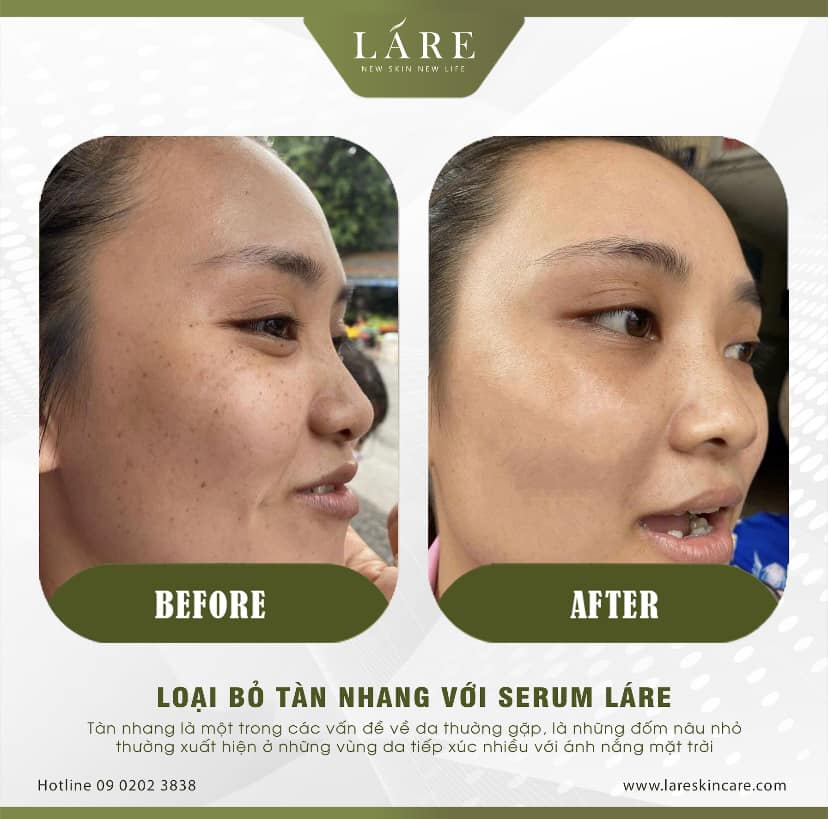 Serum thảo mộc thanh dược Lare chiết 40ml