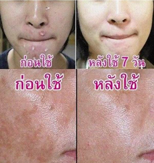 [Chính Hãng 100%] Bộ kem nám Thái Lan MEYYONG (3 hủ)