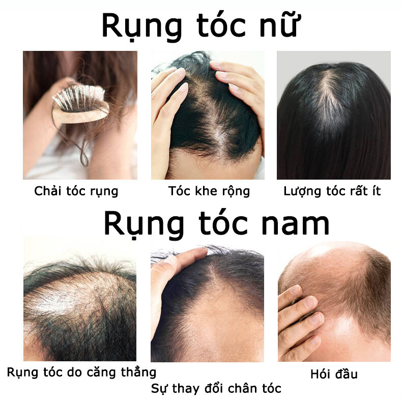 Thuốc mọc tóc serum kích mọc tóc chống rụng tóc kích mọc tóc chăm sóc tóc 30ml  kích thích mọc tóc nhanh làm dày
