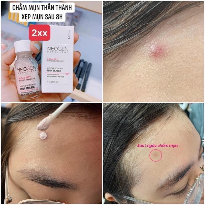 CHẤM MỤN NEOGEN A-CLEAR GIẢM MỤN HIỆU QUẢ