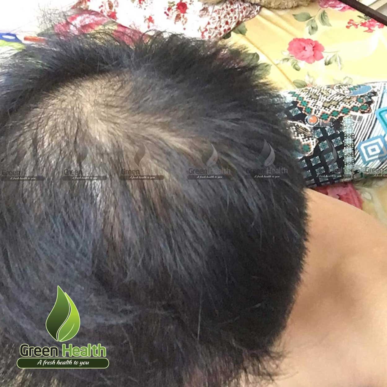 DHT HairOmega Biotin Thực Phẩm Bổ Sung Đẹp Da Tóc Móng Hàng Nhập Mỹ Cải Thiện Tình Trạng Tóc Rụng Hói Đầu Cho Bạn Mái Tóc Bóng Khỏe Dày Dặn Kích Thích Tóc