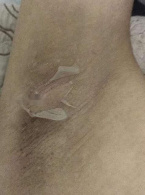 Peel Lột Da Nách Hết Thâm Trắng Mịn+ kem dưỡng
