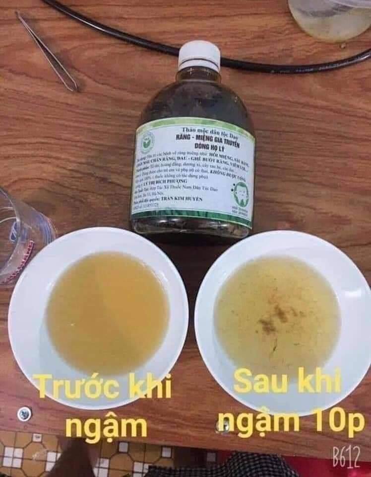 SÂU RĂNG,HÔI MIỆNG,CHẢY MÁU CHÂN RĂNG