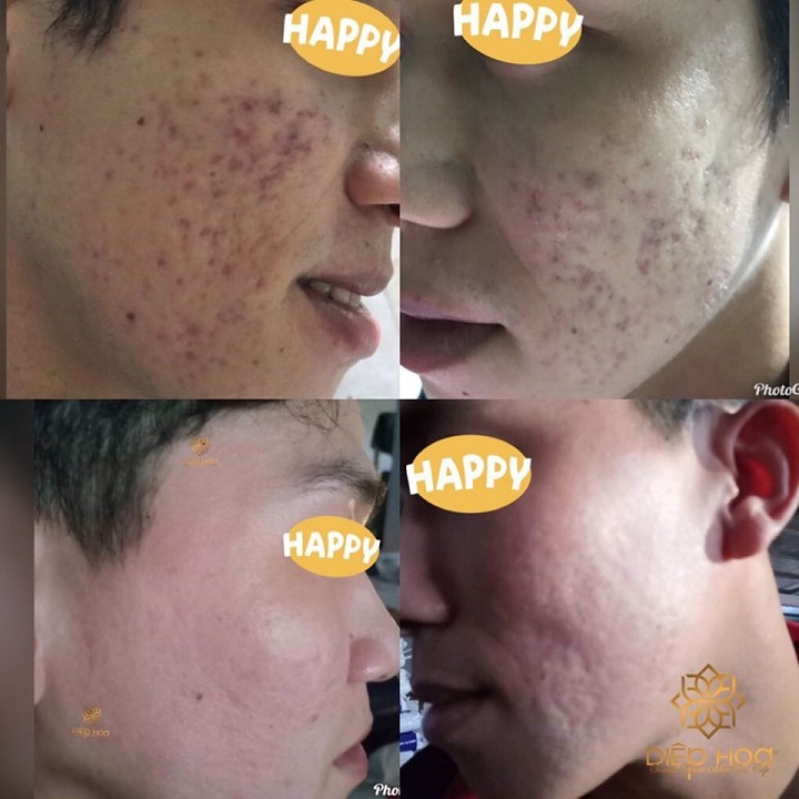 [HCM]SERUM OGANA TRỊ MỤN