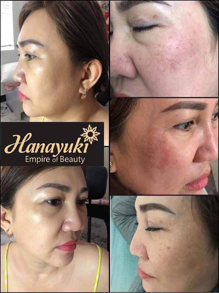 Kem Trị Nám Hanayuki - Hana Melasma Night