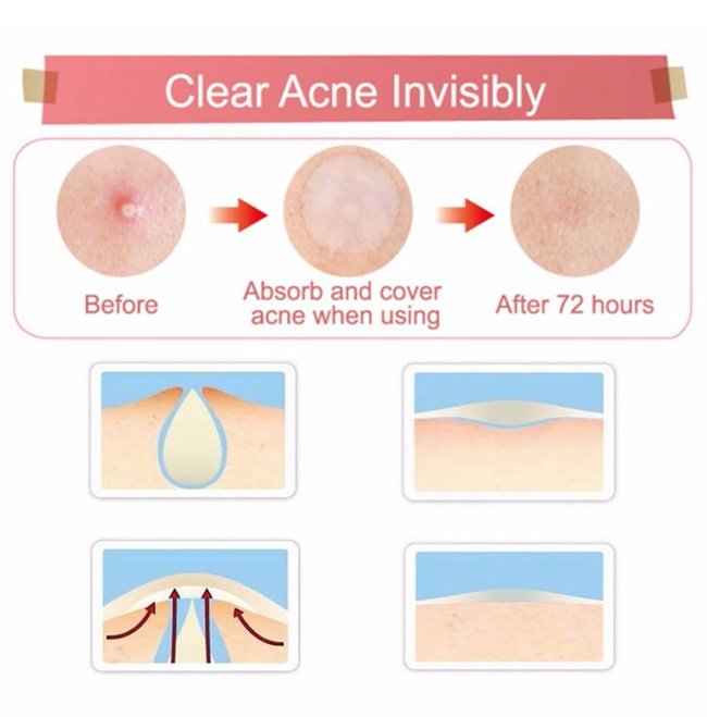 Miếng Dán Mụn Some By Mi 30 Days Miracle Clear Spot Patch (18 miếng)