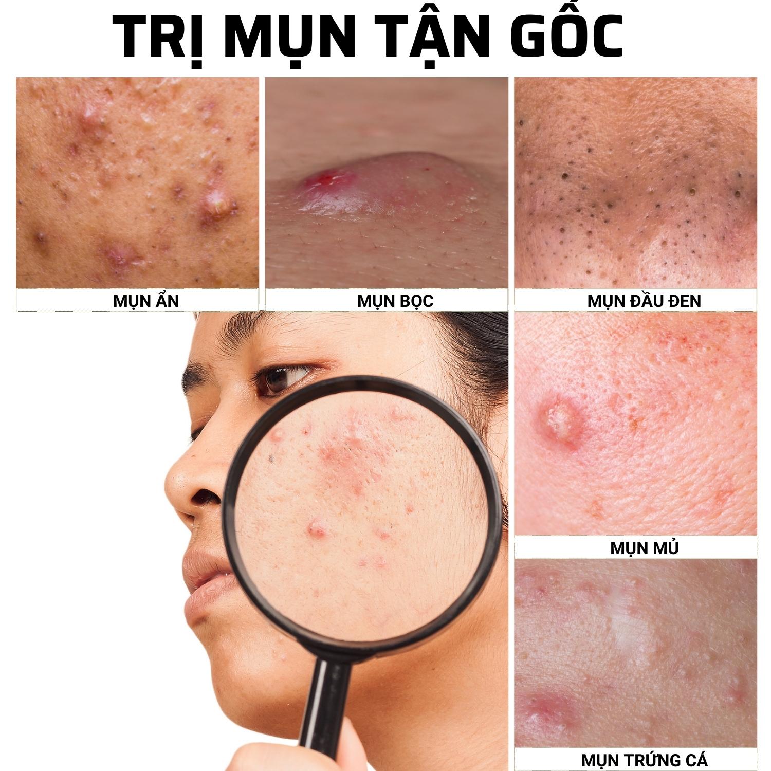 Kem Tri Mụn thâm Doctor Care Acnes Elimination 20ml
