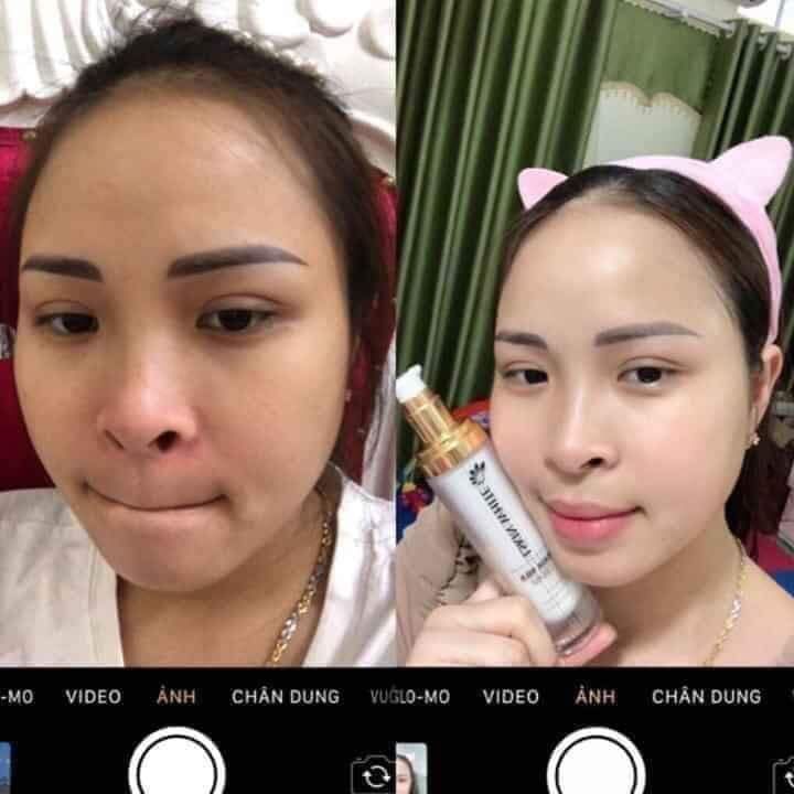 Ủ Trắng Da Kén Tằm chính hãng