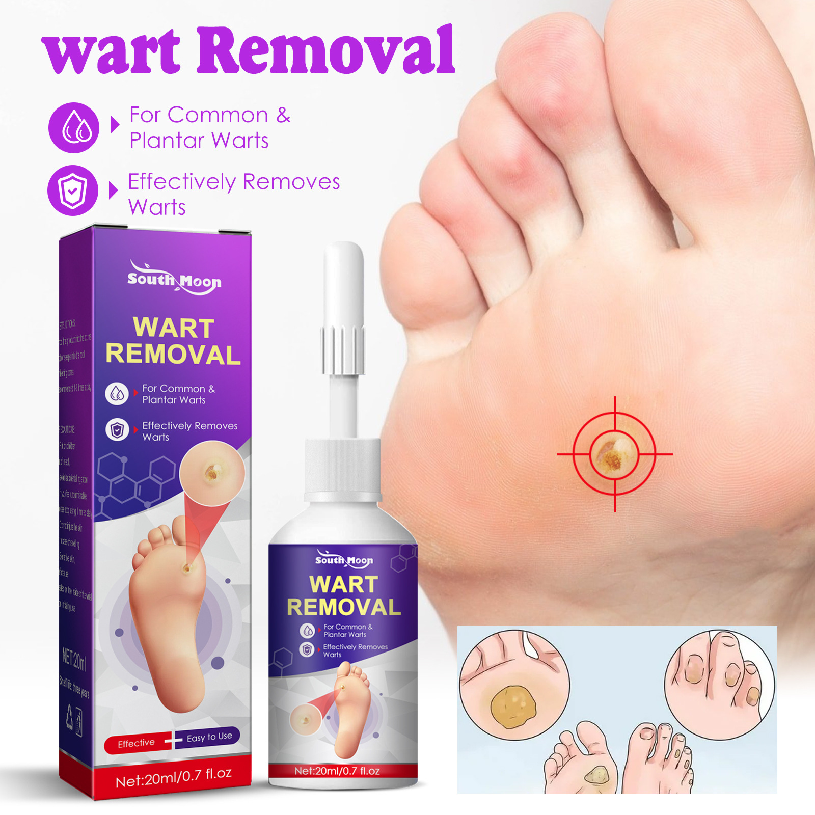 Serum bong chai sần, mụn cóc Wart Removal - Tinh chất tẩy mụn cóc, mụn cơm, chai sần biến mất 20ml - Shiny Beauty World