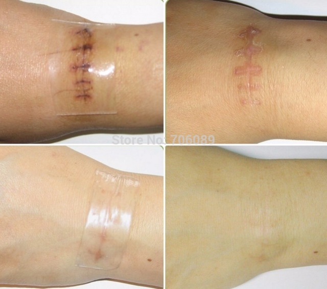 Tấm Dán Sẹo Scar FX 2*2cm  Mỹ
