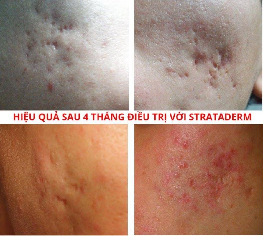 ĐIỀU TRỊ SẸO XẤU. STRATADERM GEL 10G