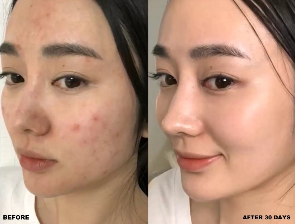 The Ordinary AHA 30% + BHA 2% Exfoliating Peeling Solution