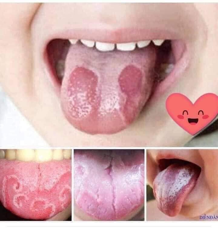 THUOC Đ.Ặ.C TR.Ị SÂU RĂNG PHÚ ÂN - CAM KẾT KHỎI DỨT ĐIỂM BỆNH RĂNG MIỆNG - NPP PIONE BOSS điều tr.ị sâu răng, sún răng, nhiệt miệng, hôi miệng, nấm lưỡi, viêm lợi, chảy máu chân răng...