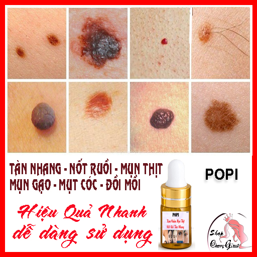 KEM TẨY MỤN CƠM, MỤN CÓC, NỐT RUỒI, MỤN THỊT, TÀN NHANG POPI