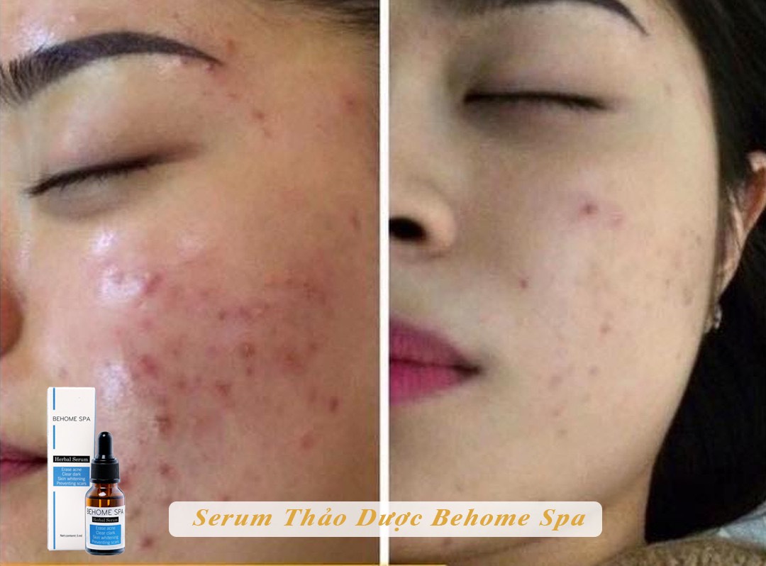 [HCM]SERUM THẢO DƯỢC BEHOMESPA