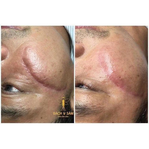 CAO SẸO BÁCH Y SÂM - CAO SẸO THẢO DƯợc BẠCH LINH ( mẫu mới cô đặc )