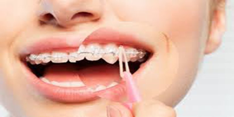 Combo 2 cái dụng cụ kéo thun liên hàm chỉnh nha