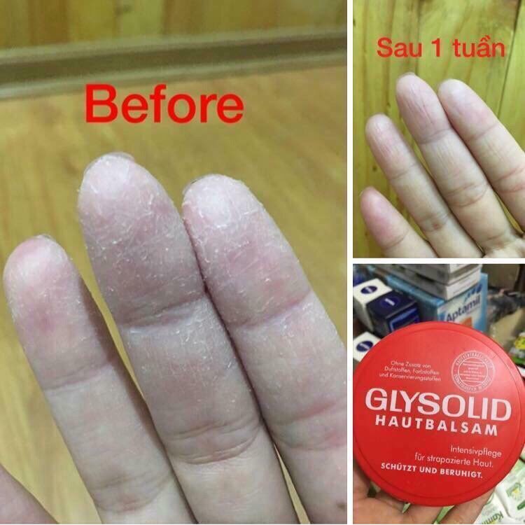 Kem nẻ Glysolid Hautbalsam, 100 ml của Đức