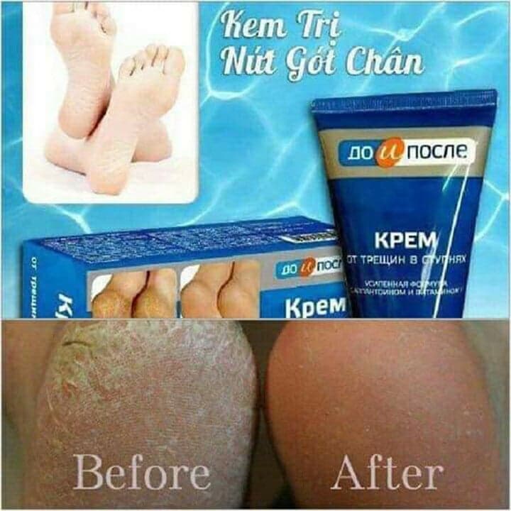 [HCM]Kem Nứt Gót Chân Kpem Nga 50ml