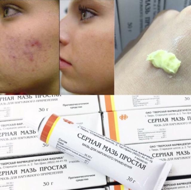 [HCM]Trị Mụn Lưu Huỳnh Cephar Nga