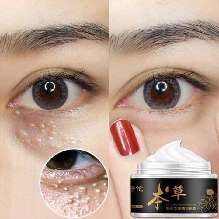 KEM XÓA MỤN THỊT - BỌNG MẮT - QUẦNG THÂM MẮT