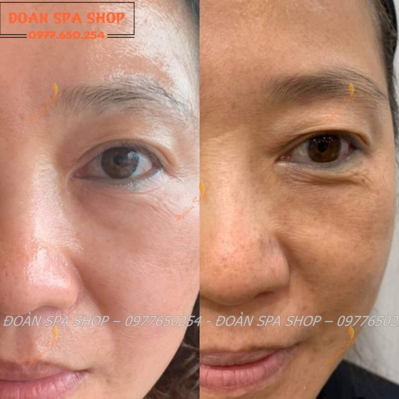 Bộ Phân Hủy Nám Luxury DevaCell - Deva cell