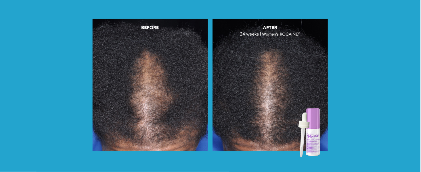 Kem mọc tóc nữ Rogaine 2% Minoxidil Topical Solution 60ml