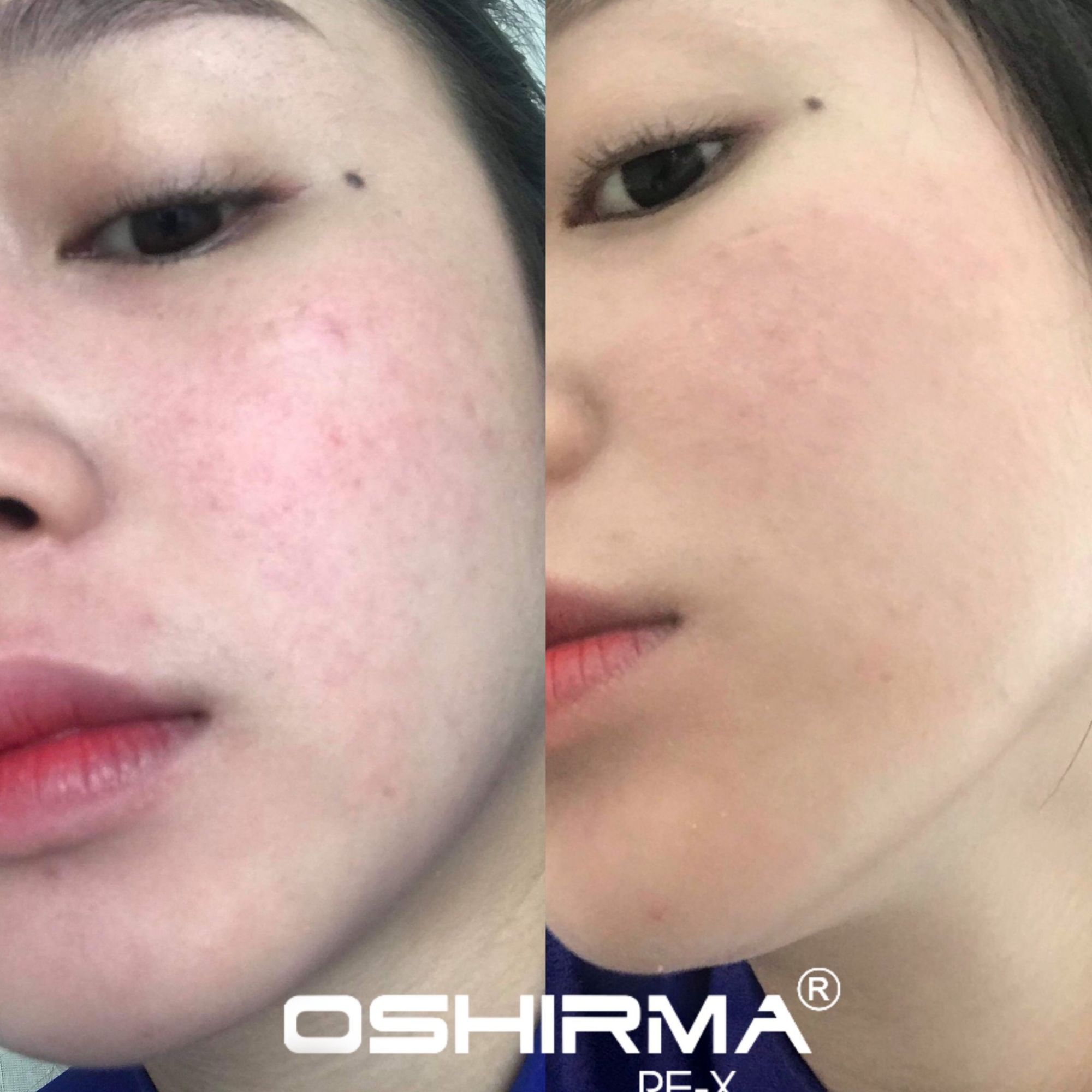 Bộ Phục Hồi Da Yếu Nhạy Cảm Oshirma