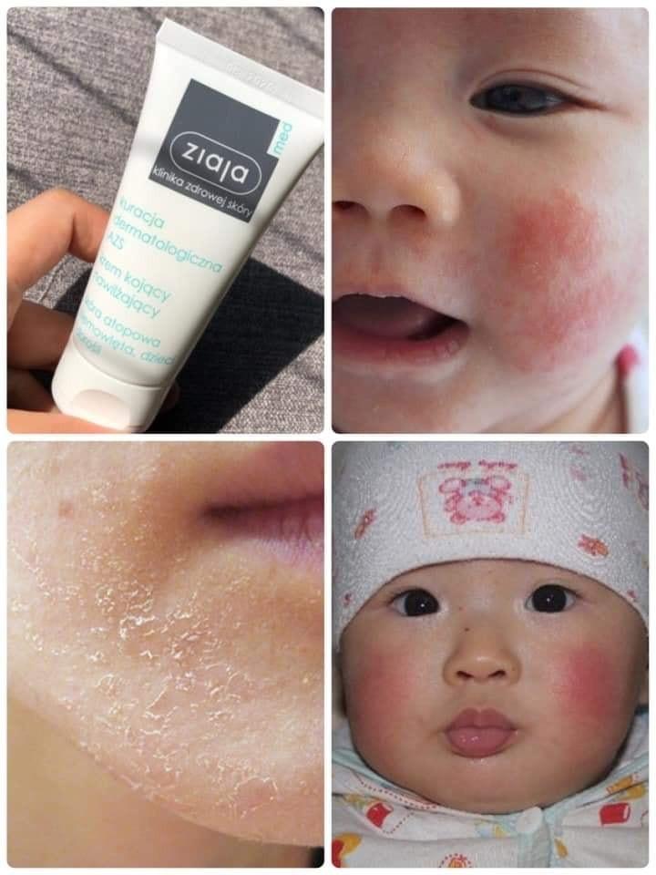 KEM CHĂM SÓC DA ZIAJA MED ATOPY 50ML.