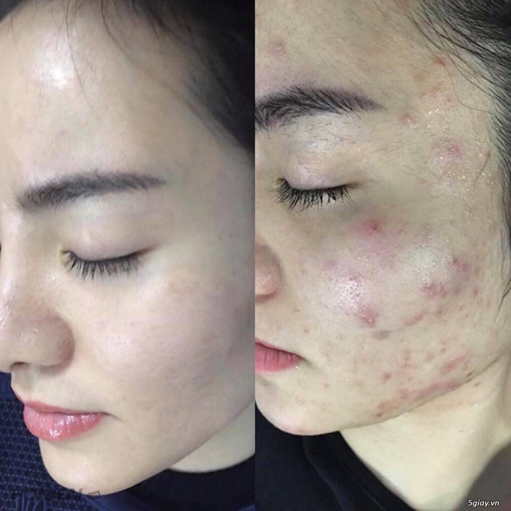 Chấm mụn siêu tốc Linh Sâm 12 lọ