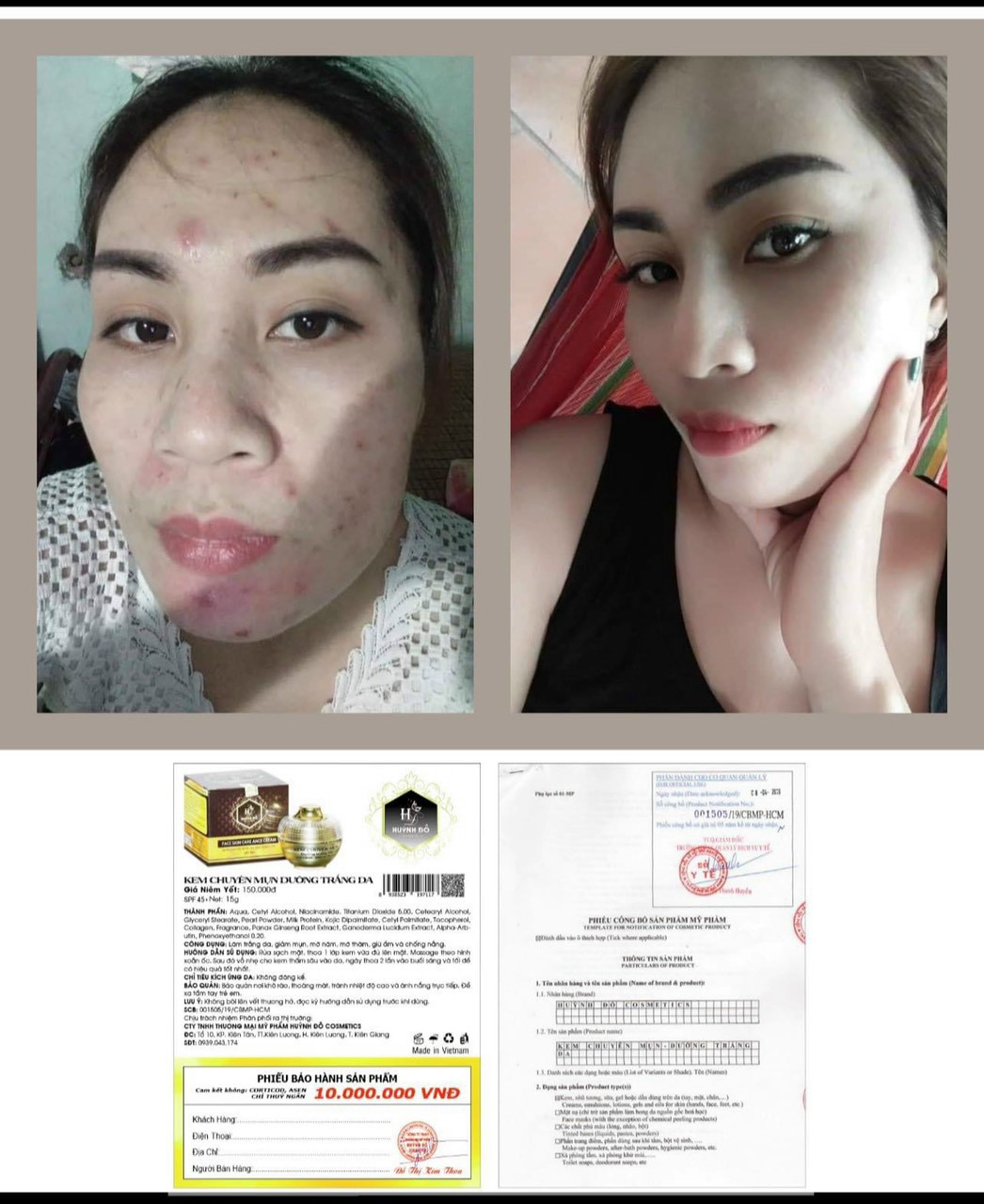 Kem FACE chuyên mụn - Trắng da HUỲNH ĐỖ