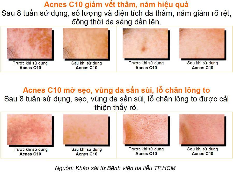 DUNG DỊCH LÀM MỜ SẸO VÀ VẾT THÂM - ACNES C10 15ML